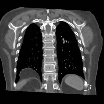 Bochdalek hernia | Radiology Reference Article | Radiopaedia.org