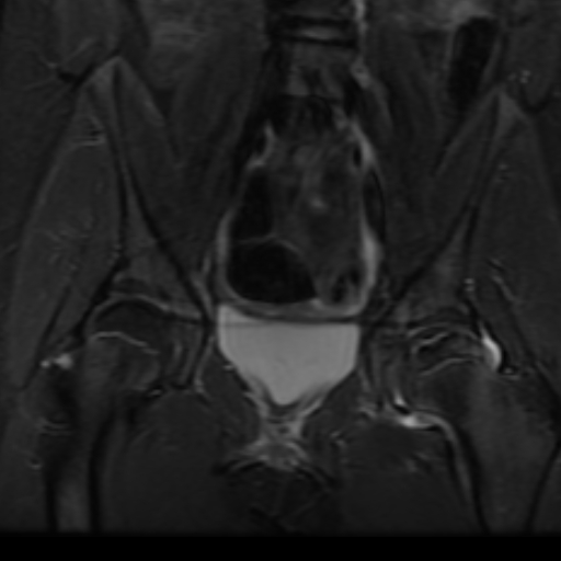 Osteochondritis Dissecans Of The Femoral Head 