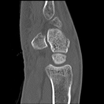 Triquetral fracture | Radiology Case | Radiopaedia.org