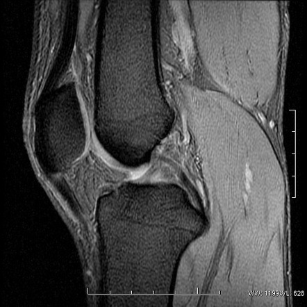 Infrapatellar plica injury | Image | Radiopaedia.org