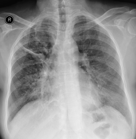 Cavitary pulmonary tuberculosis | Radiology Case | Radiopaedia.org