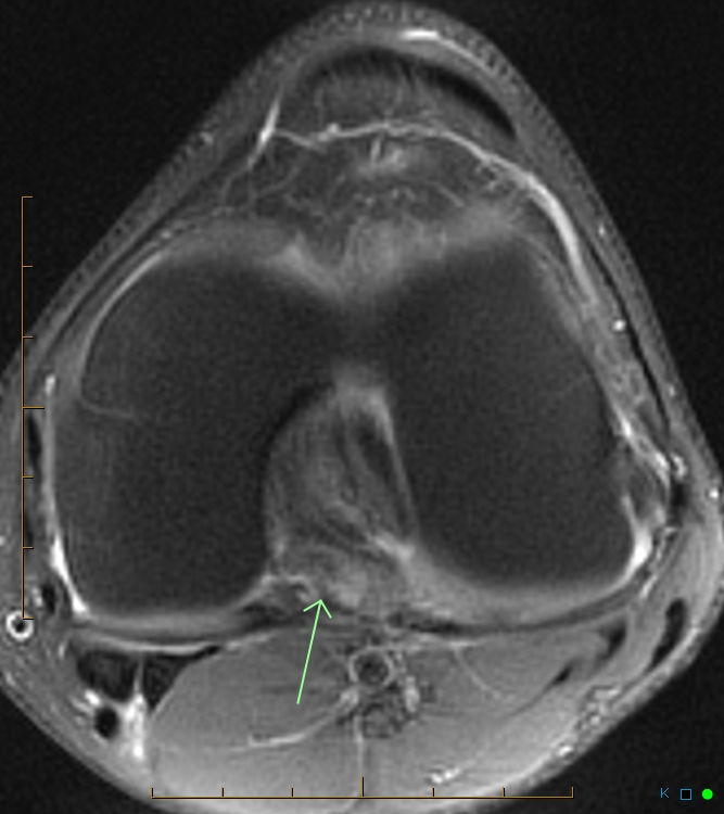 Xknee Startradiology Cruciate Ligament Radiology