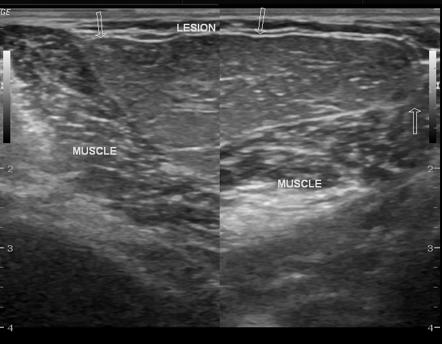 Subcutaneous lipoma of arm | Image | Radiopaedia.org