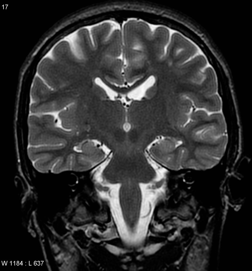 Aicardi syndrome | Image | Radiopaedia.org