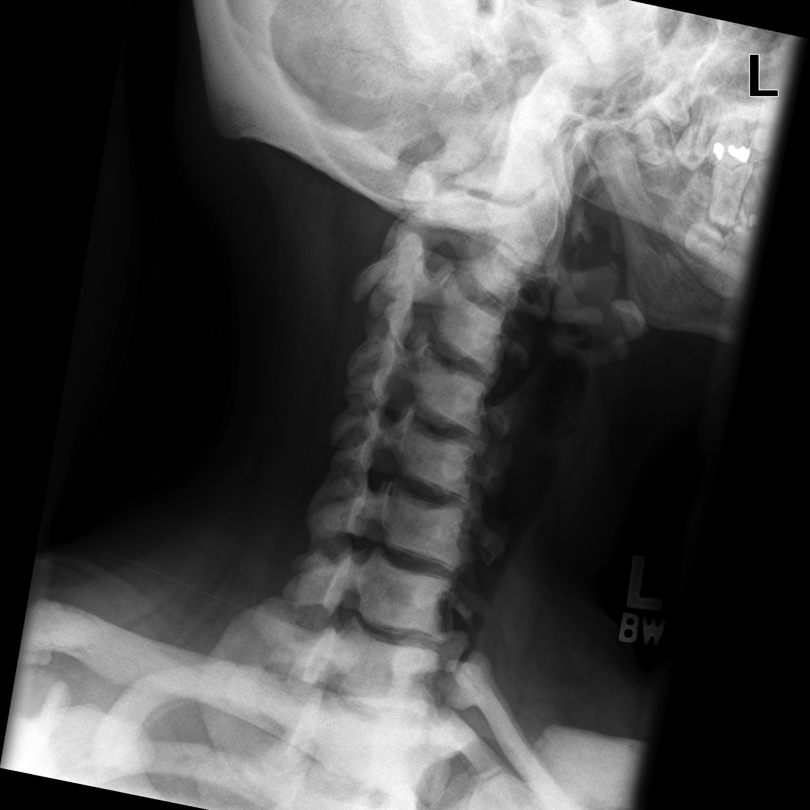 Osteopetrosis | Image | Radiopaedia.org