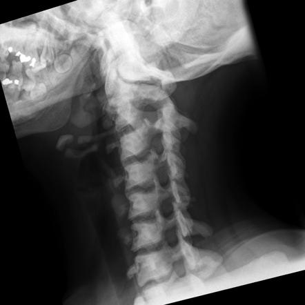 Osteopetrosis | Image | Radiopaedia.org