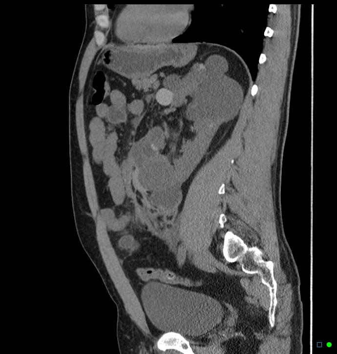 Spontaneous hemorrhage in polycystic renal disease | Image ...