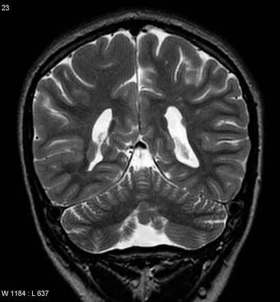 Aicardi syndrome | Radiology Reference Article | Radiopaedia.org