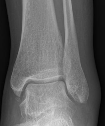 Anterior Talofibular Ligament Injury With An Avulsed Bone Fragment From ...