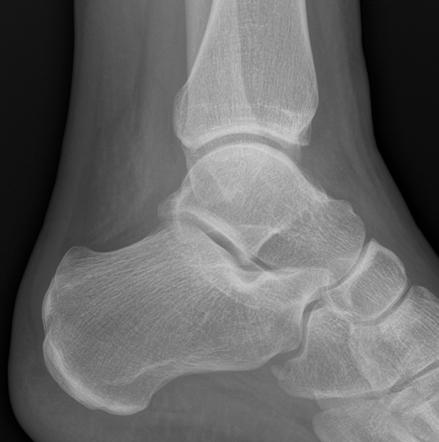 Anterior Talofibular Ligament Injury With An Avulsed Bone Fragment From ...