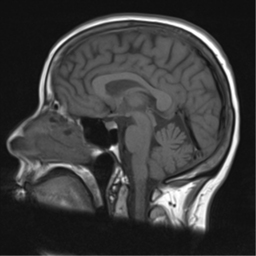 Creutzfeldt-Jakob disease | Image | Radiopaedia.org