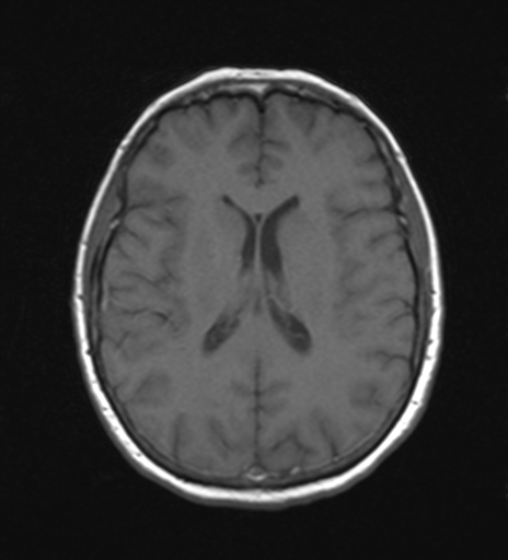 Creutzfeldt-Jakob disease | Image | Radiopaedia.org