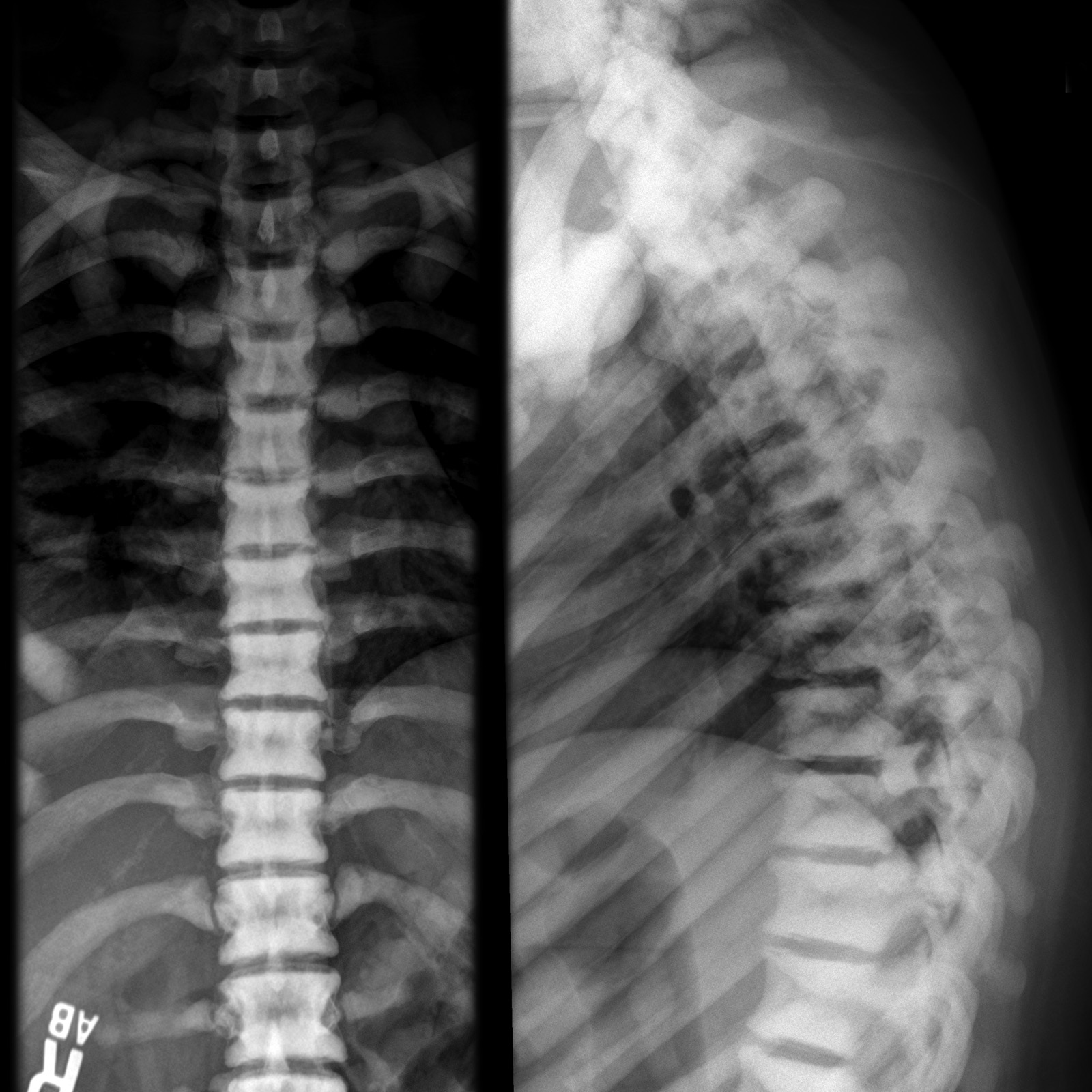 Osteopetrosis | Image | Radiopaedia.org