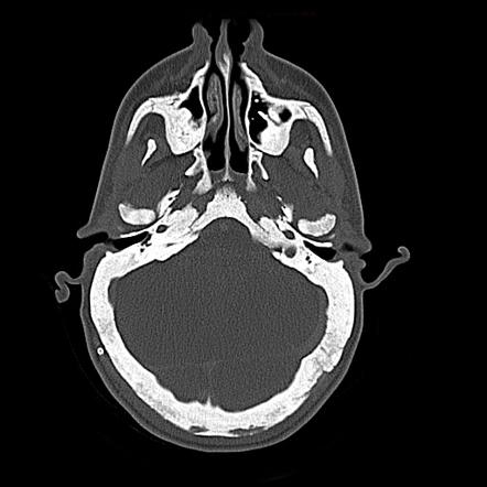 Osteopetrosis | Radiology Reference Article | Radiopaedia.org