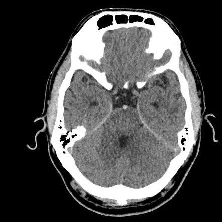 Top of the basilar thrombosis | Radiology Case | Radiopaedia.org