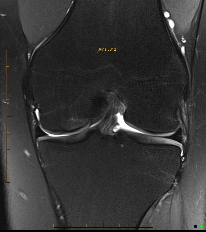 Healing OCD lesion medial femoral condyle | Image | Radiopaedia.org