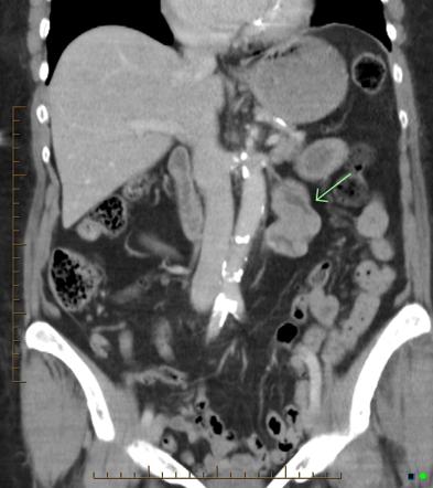 duodenal polyp distal radiopaedia venous coronal