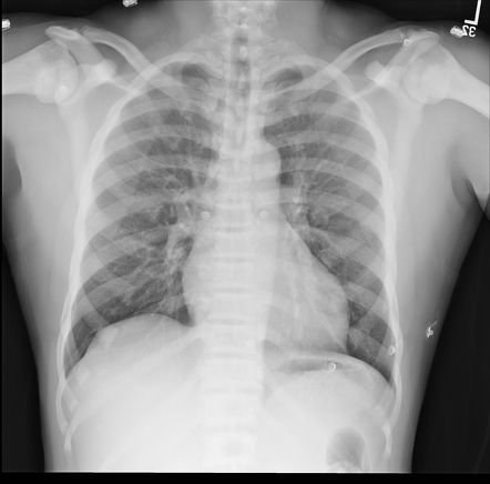 Osteomesopyknosis | Radiology Reference Article | Radiopaedia.org