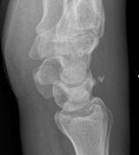 Triquetral Fracture