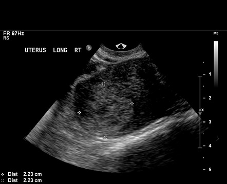 Interstitial ectopic pregnancy | Radiology Reference Article ...