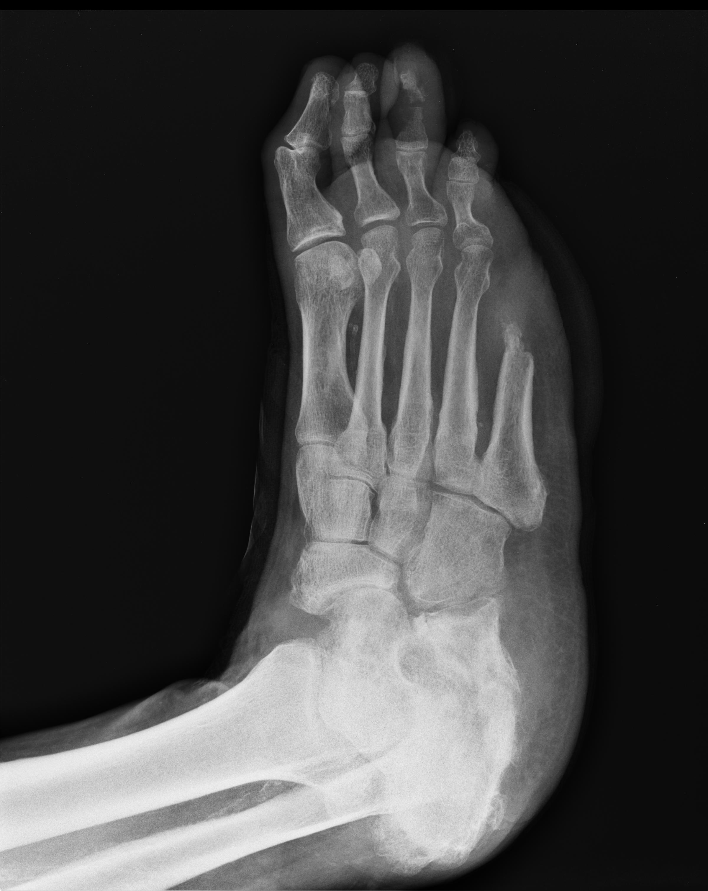 Diabetic foot | Image | Radiopaedia.org