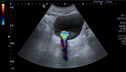 Color comet tail artifact | Image | Radiopaedia.org