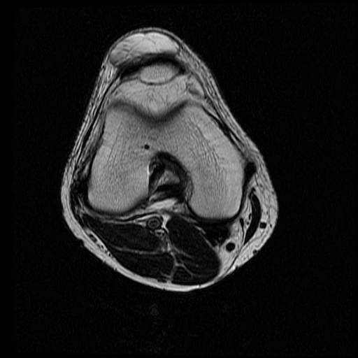 Prepatellar bursitis | Image | Radiopaedia.org