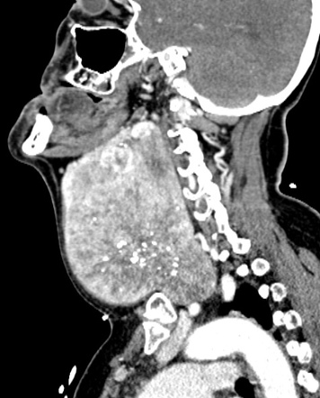 Goiter Radiology Reference Article Radiopaedia Org