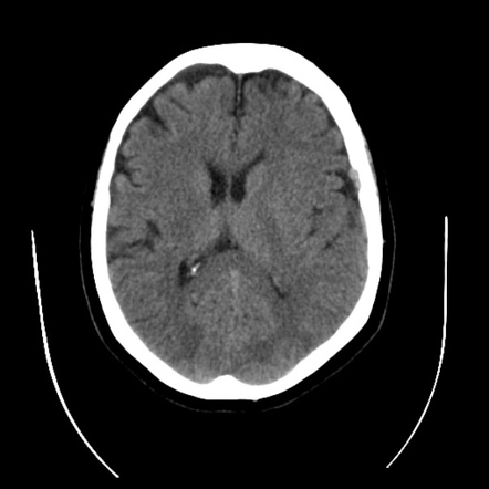 Cerebral arteriovenous malformation | Image | Radiopaedia.org