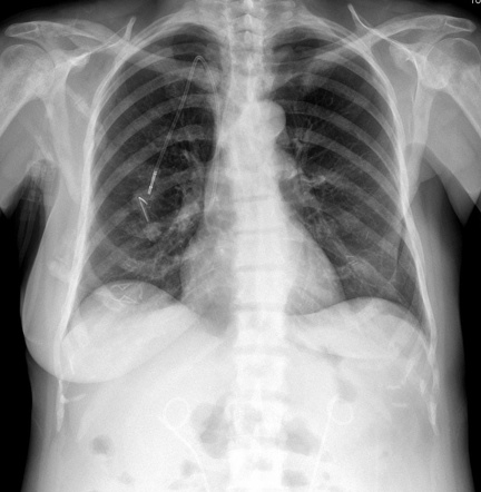 Pseudopneumoperitoneum | Image | Radiopaedia.org