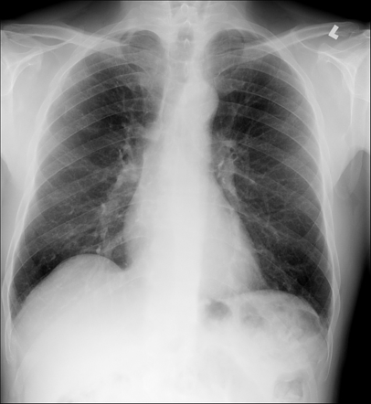 Usual interstitial pneumonia in rheumatoid arthritis with possible ...