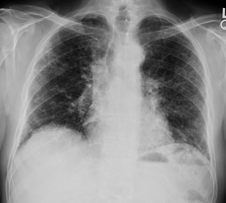 Usual interstitial pneumonia in rheumatoid arthritis with possible ...