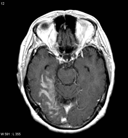 Gyral enhancement | Radiology Reference Article | Radiopaedia.org