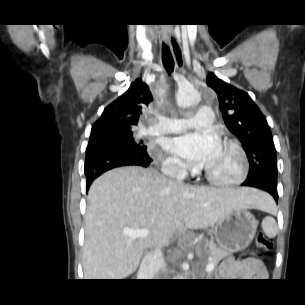 Tuberculous mediastinal lymphadenopathy | Image | Radiopaedia.org