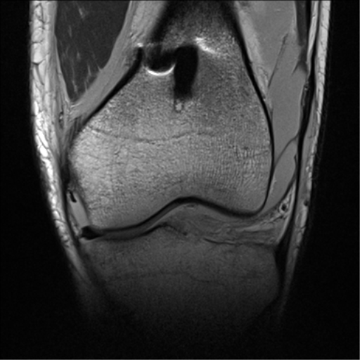 Posterior cruciate ligament avulsion fracture | Image | Radiopaedia.org