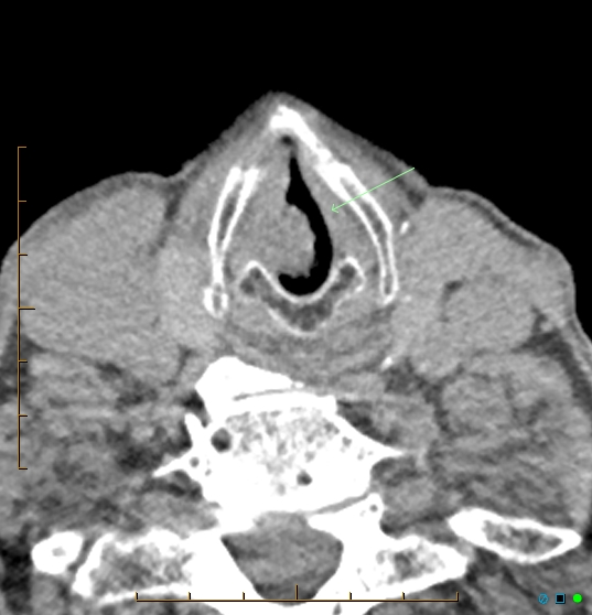 Vocal Cord Papilloma Image