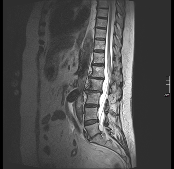 Acute spinal cord ischemia | Image | Radiopaedia.org