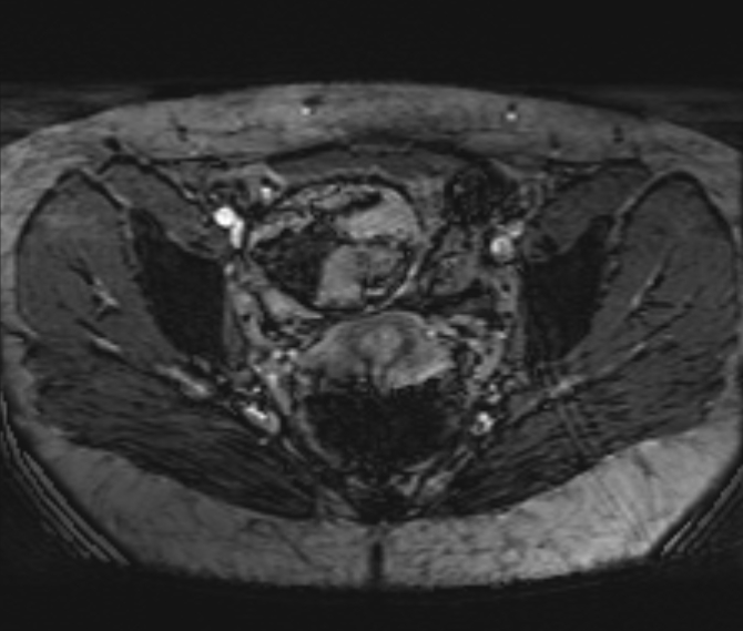 Ovarian Mature Cystic Teratoma Image Radiopaedia Org