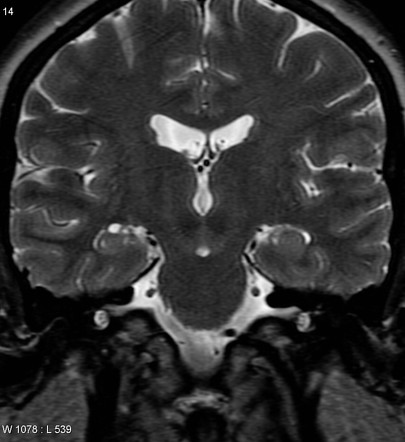 Choroidal Fissure Cyst Radiology