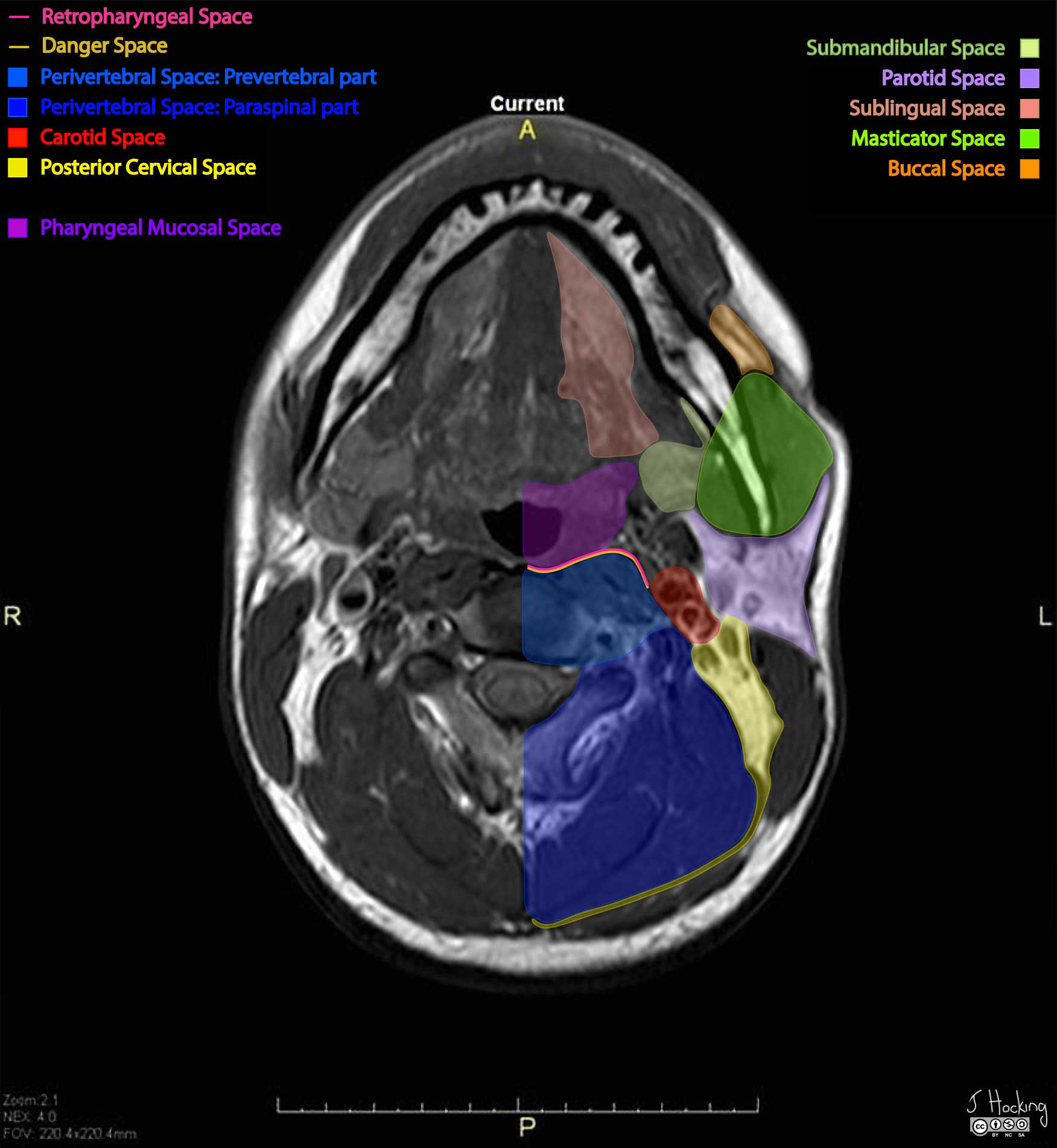 Ct Neck Axial Anatomy Anatomy Of The Neck Radiology S