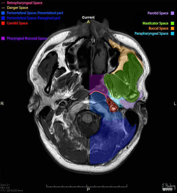 Buccal space Radiology Reference Article Radiopaedia