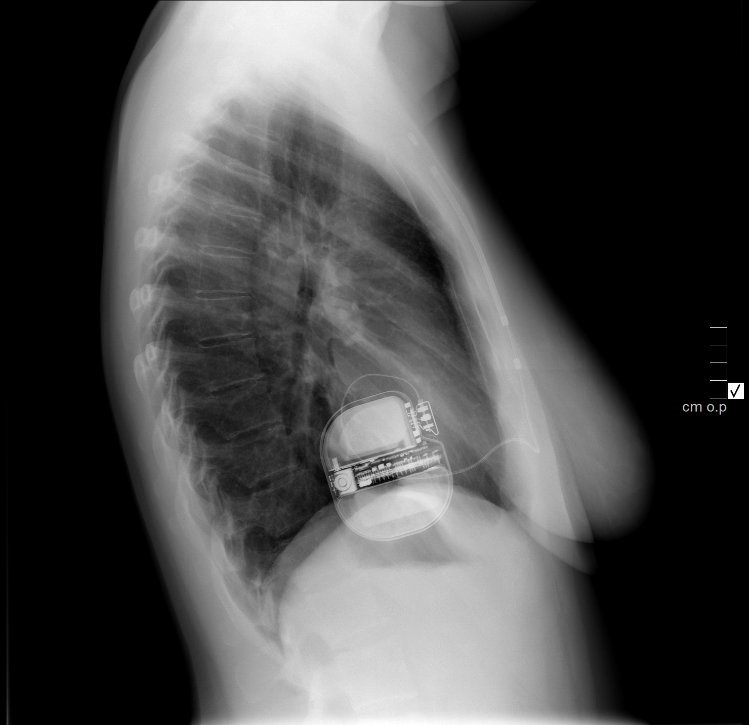 Subcutaneous Implantable Cardioverter Defibrillator | Image ...