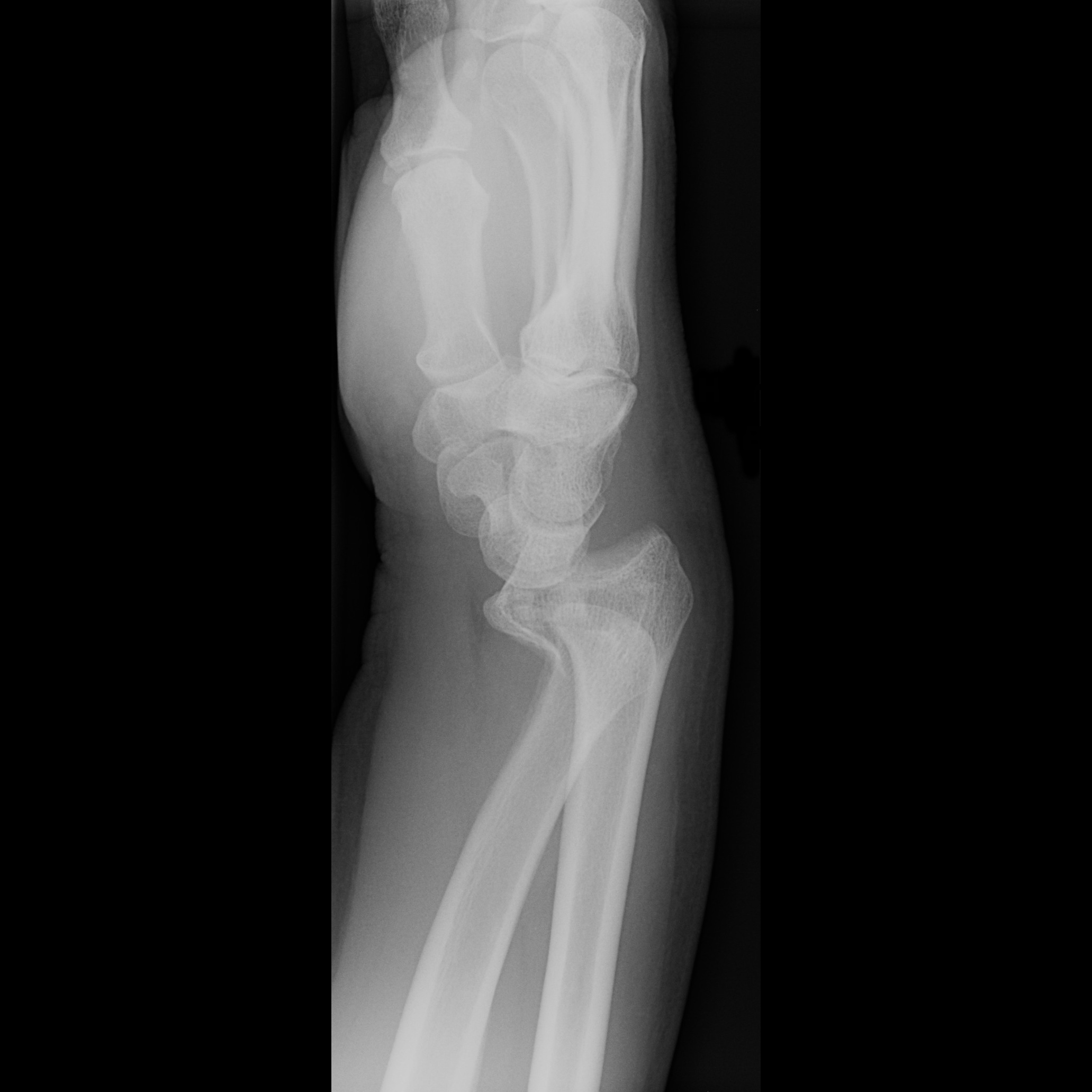 Smith fracture | Image | Radiopaedia.org