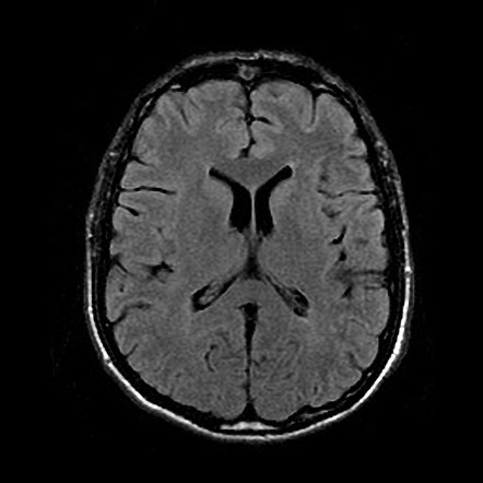 Central-variant posterior reversible encephalopathy syndrome (PRES ...