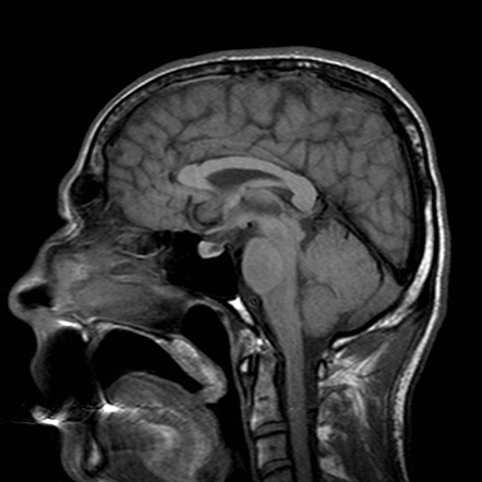 Playlist 'Posterior reversible encephalopathy syndrome' by Mohammed ...