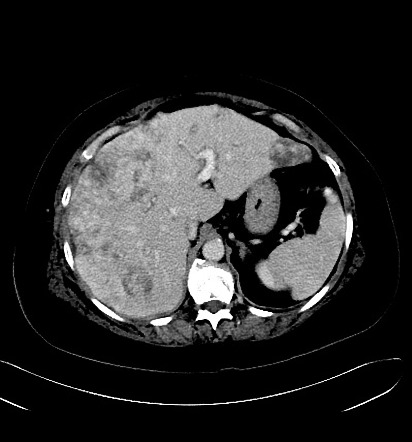 Hepatic epithelioid hemangioendothelioma | Radiology Reference Article ...