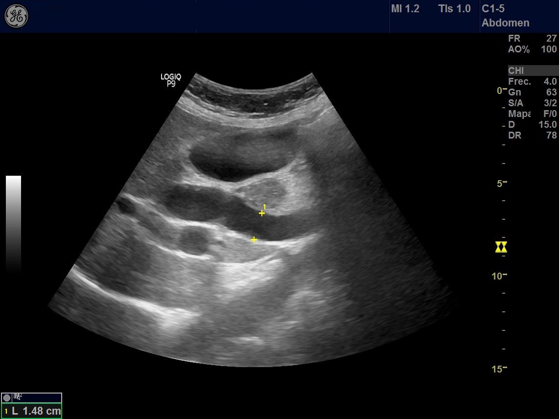 Cholelithiasis and choledocholithiasis | Image | Radiopaedia.org