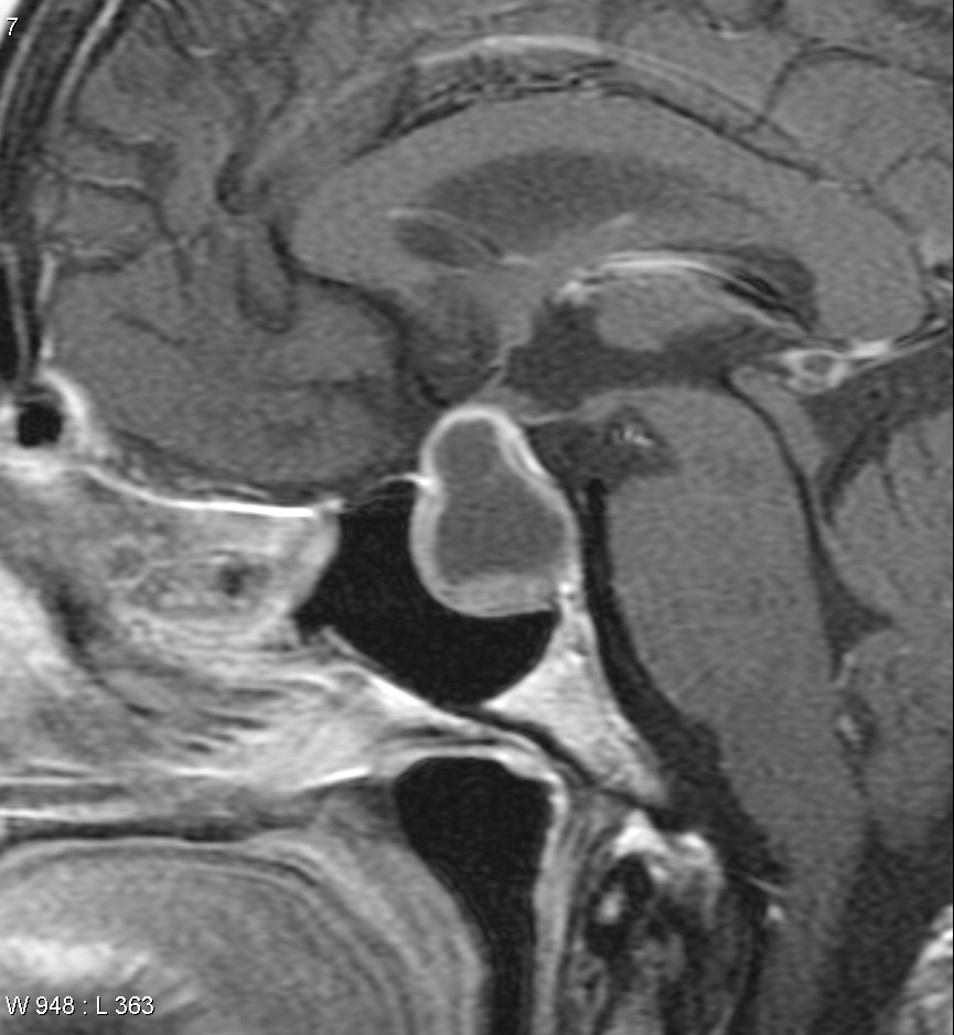 Pituitary Macroadenoma - Necrotic | Image | Radiopaedia.org