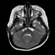 fourth ventricle mri