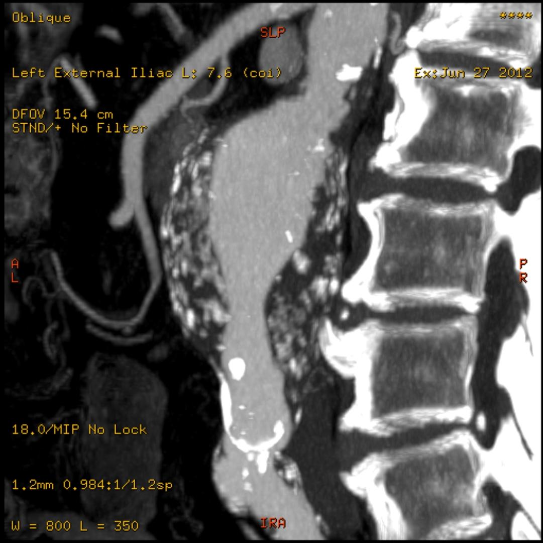 Infrarenal abdominal aortic aneurysm and arc of Riolan | Image ...